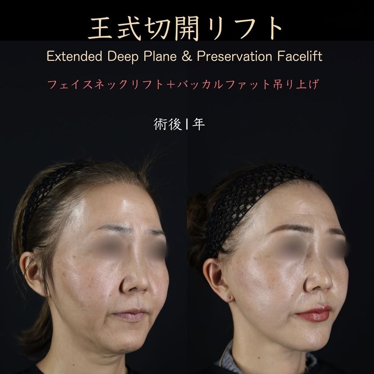 切開リフト