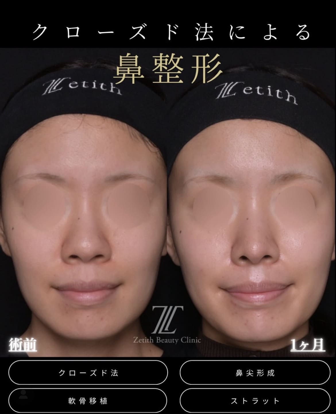鼻整形