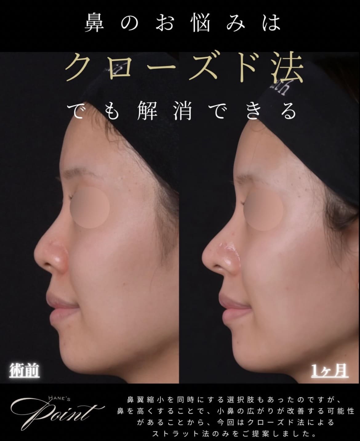 羽根医師による鼻整形術前/術後1ヶ月 After 