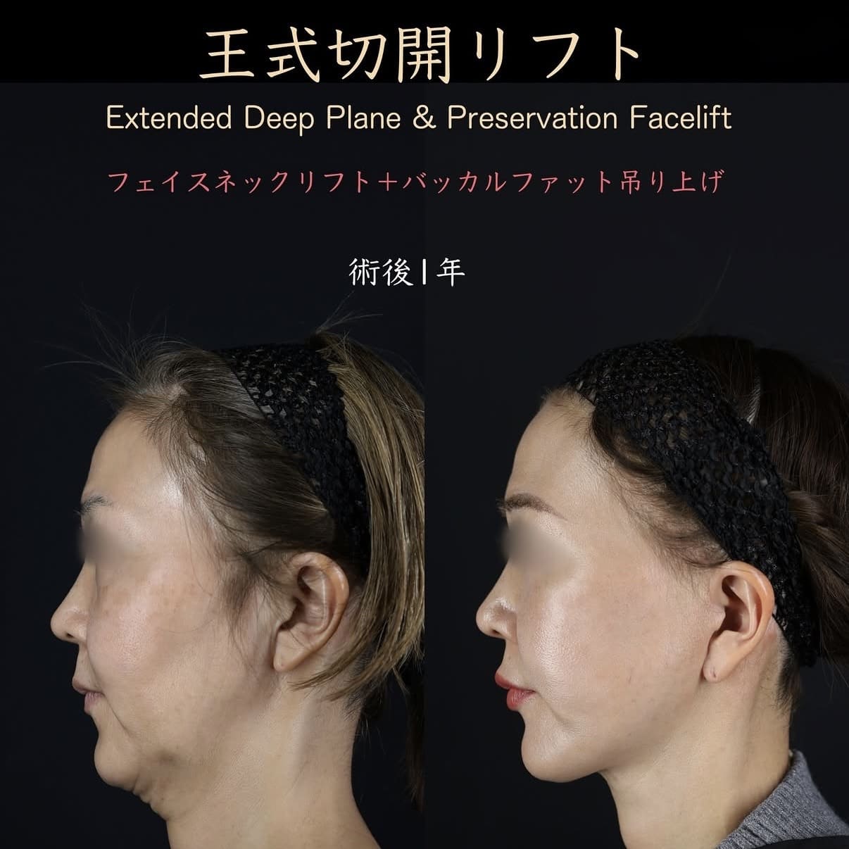 王医師によるフェイスリフトの術前/術後1年 施術後 