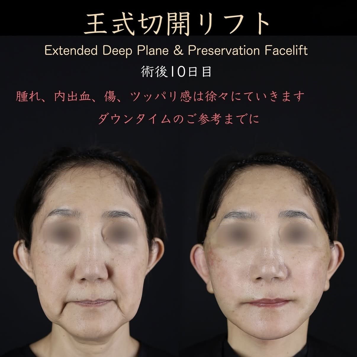 王医師によるフェイスリフトの術前/術後10日目 หลัง 