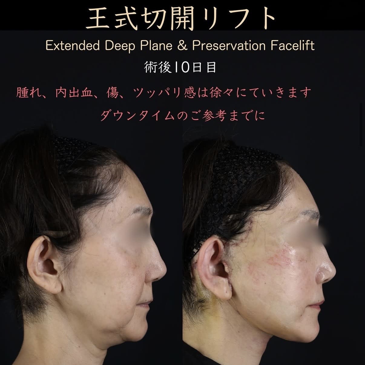 切開リフト