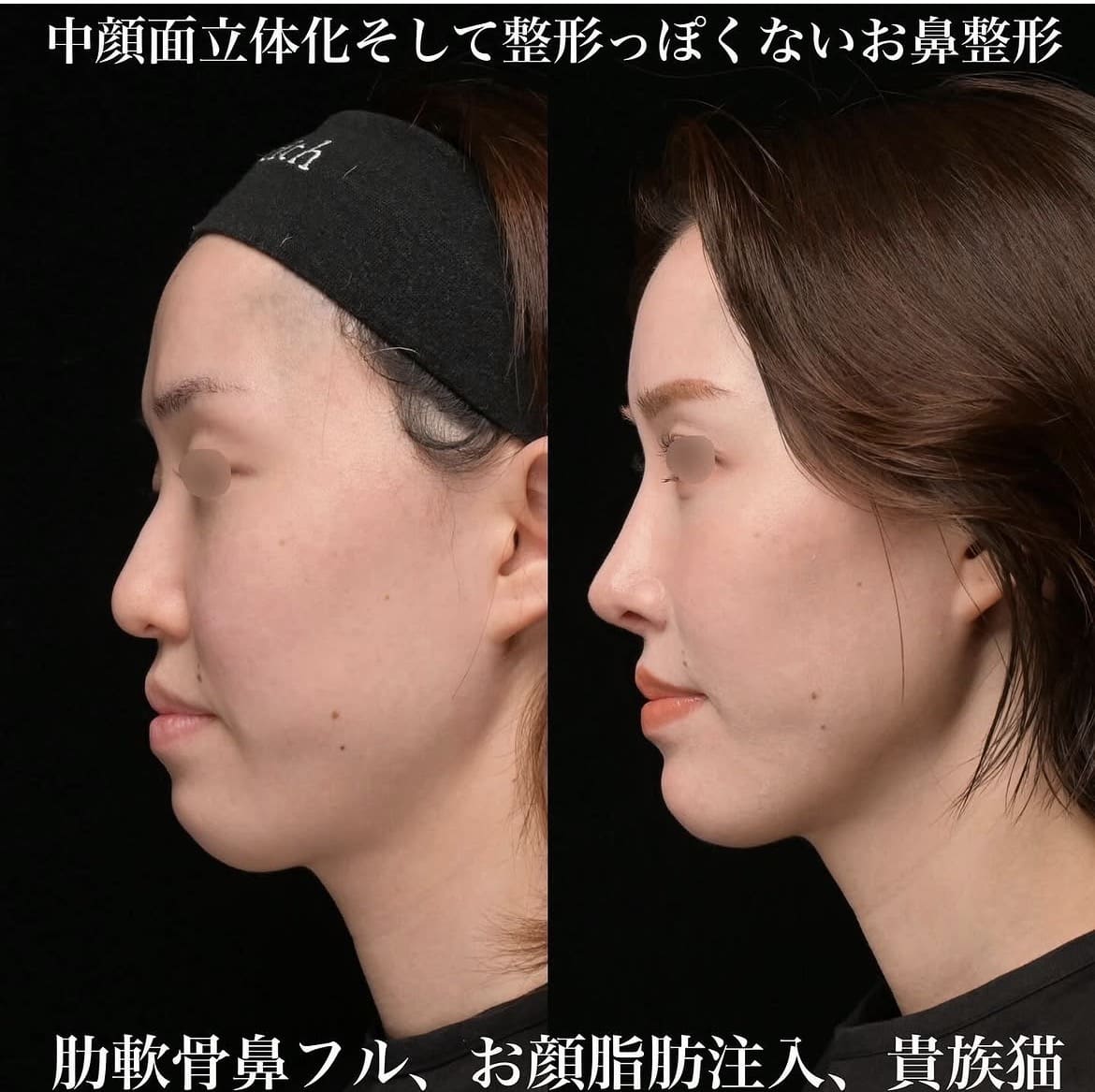 鉄医師による鼻整形術前/術後3ヶ月 术后 