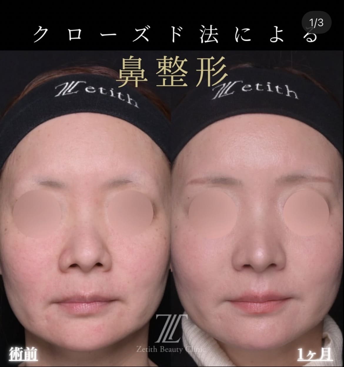 鼻整形