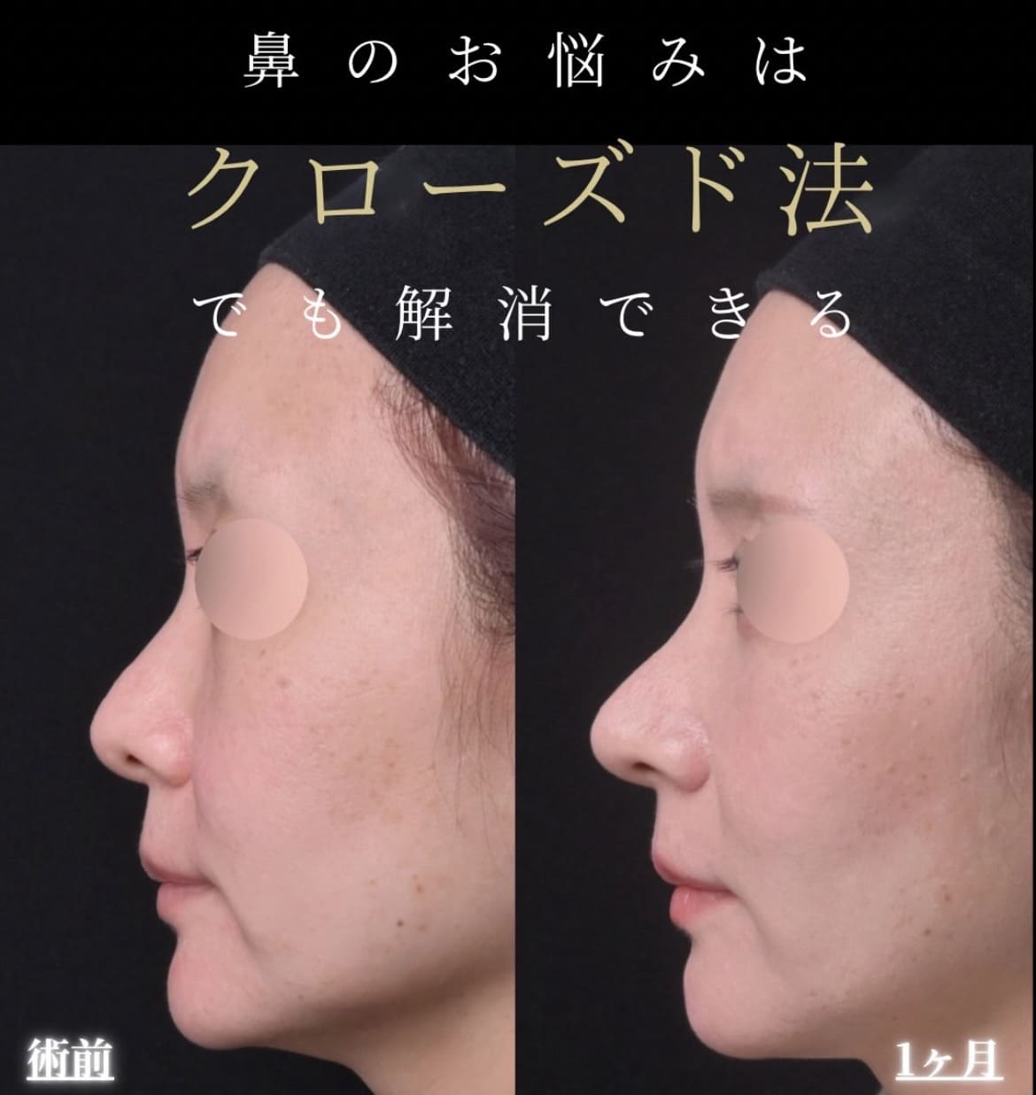 羽根医師による鼻整形術前/術後1ヶ月 بعد 