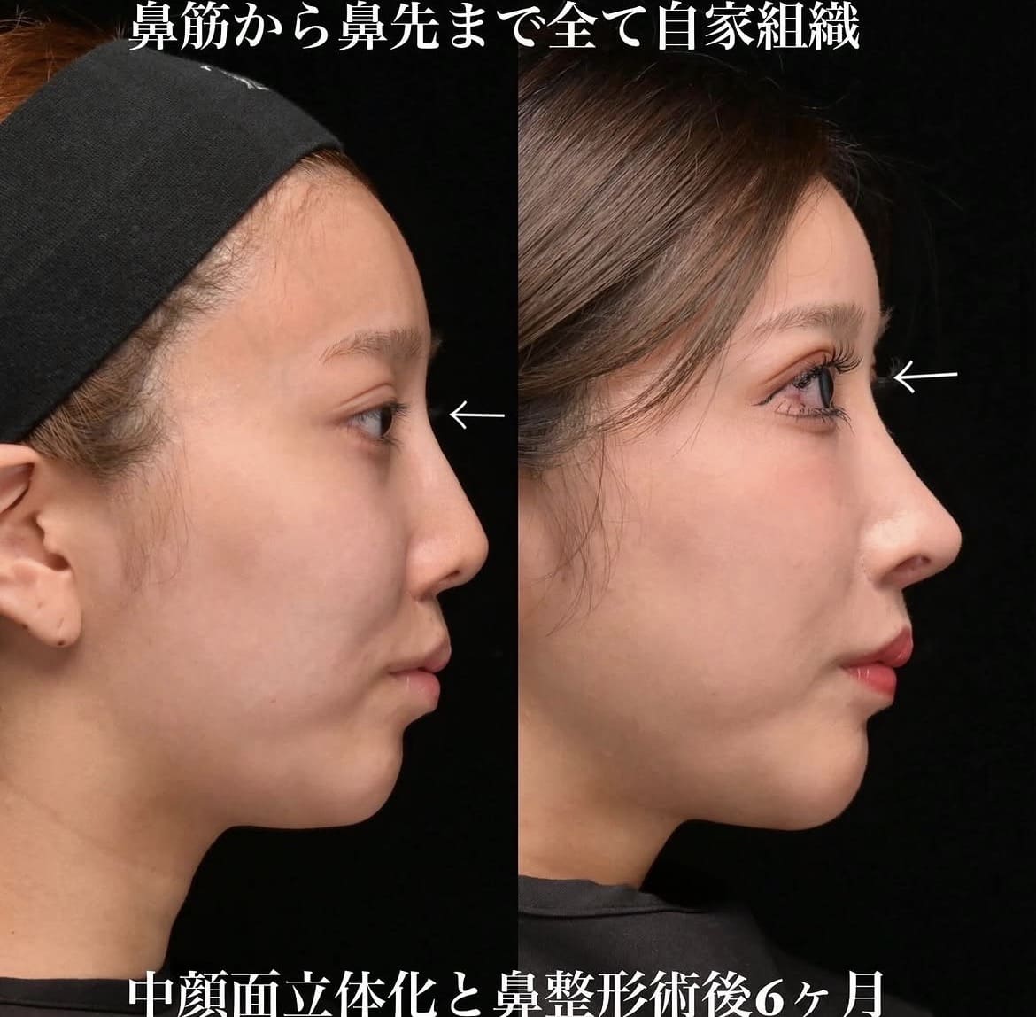鉄医師による鼻整形術前/術後6ヶ月 施術後 