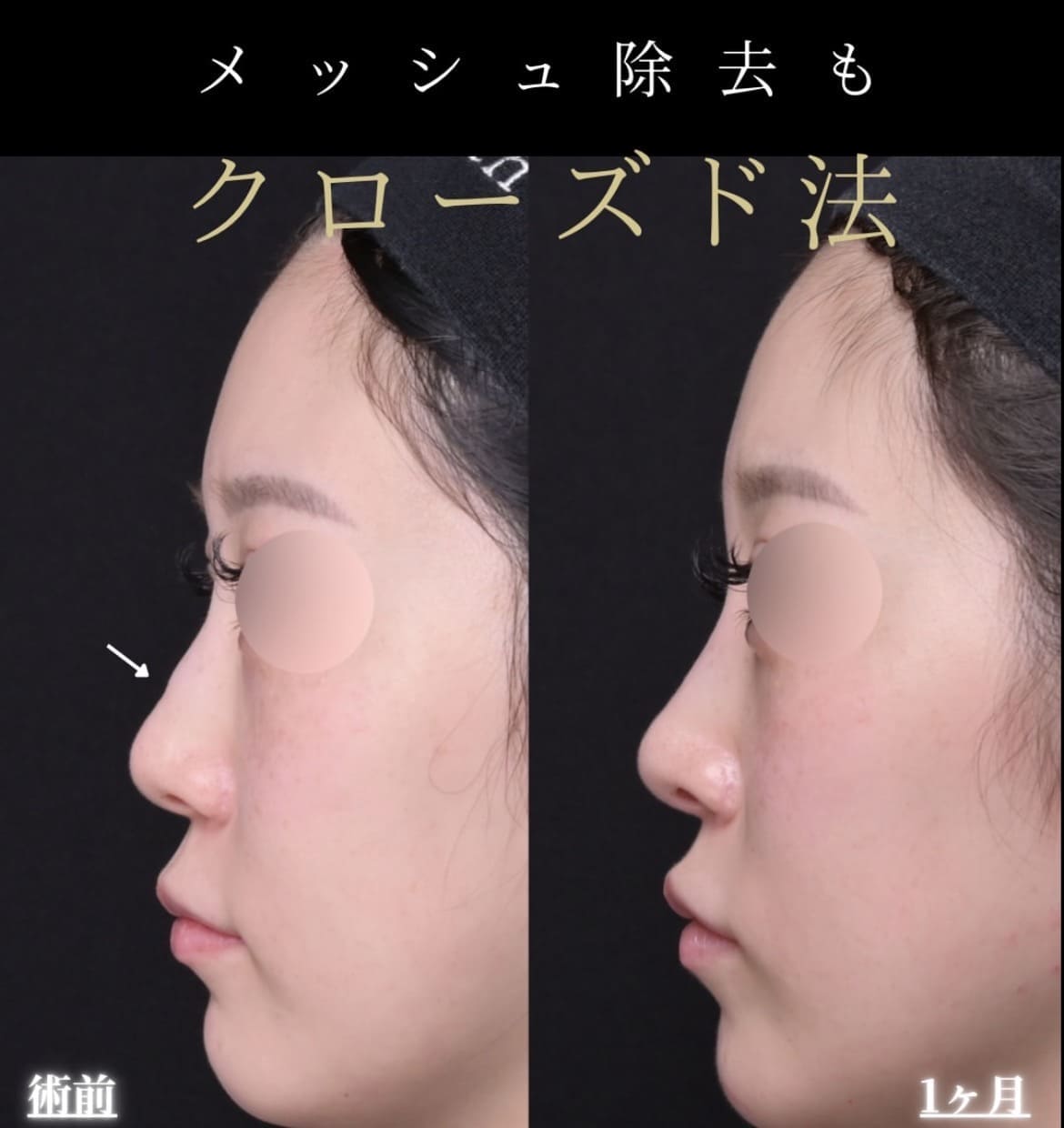 羽根医師による鼻整形術後/1ヶ月 After 