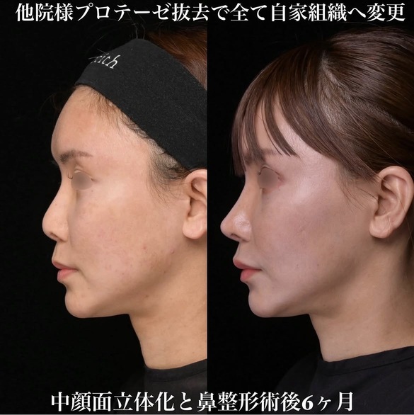 鉄医師による鼻整形術前/術後6ヶ月 施術後 