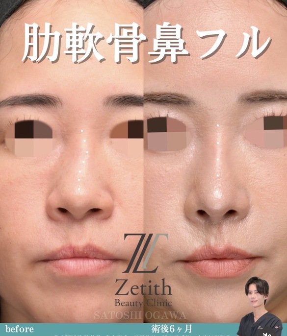 Nose | By Concern — Zetith Beauty Clinic