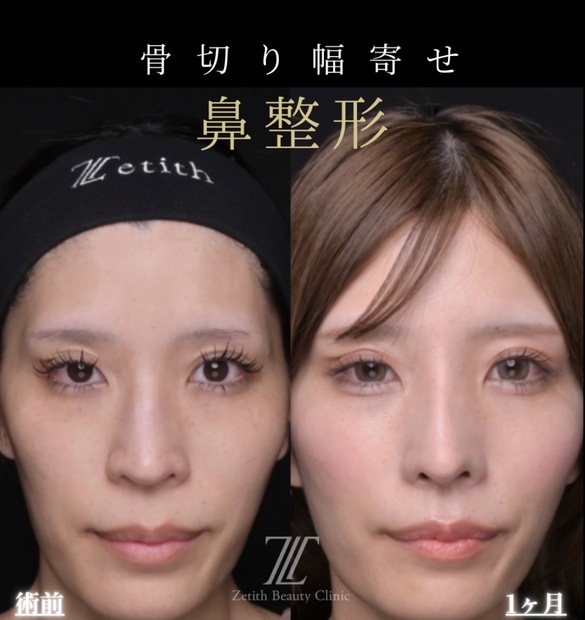 Nose | By Concern — Zetith Beauty Clinic