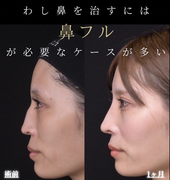 羽根医師による鼻整形術前/術後1ヶ月 بعد 