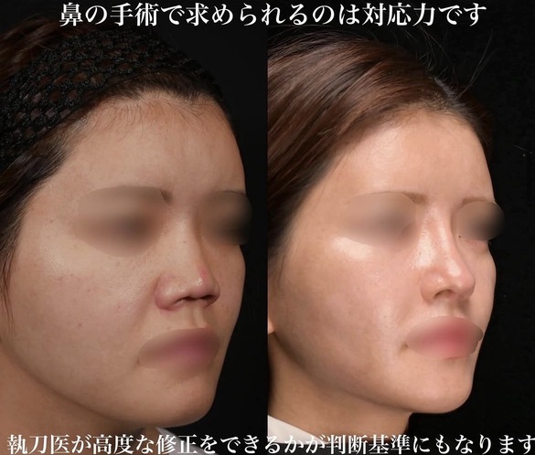 鉄医師による鼻整形術前/術後3ヶ月 หลัง 