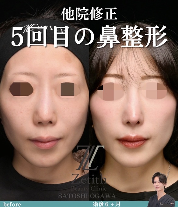 鼻整形