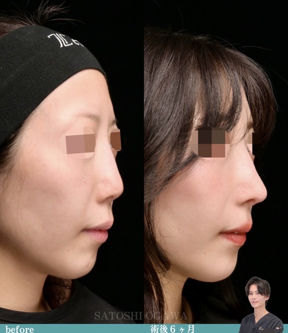 小川医師による鼻整形術前/術後6ヶ月 施術後 