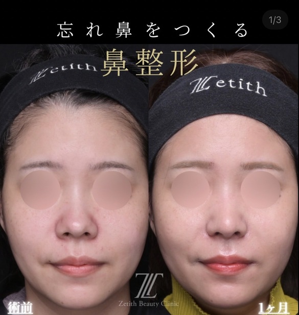 鼻整形