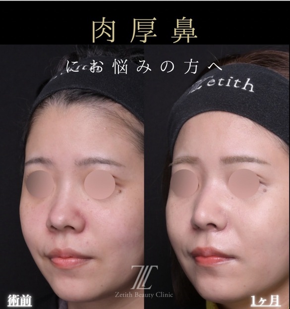 羽根医師による鼻整形の術前/術後1ヶ月 施術後 
