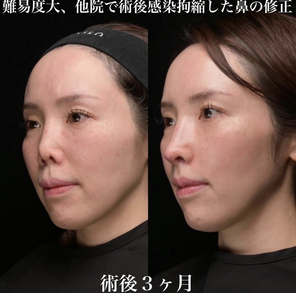 鉄医師による鼻整形術前/術後3ヶ月 施術後 