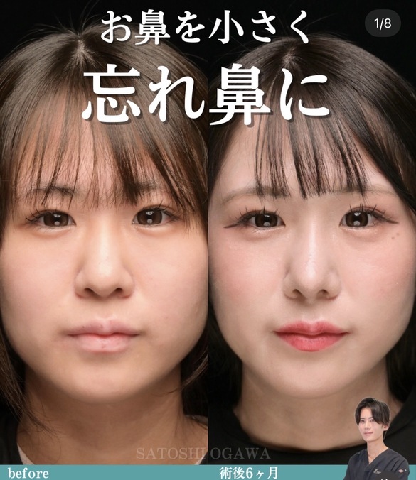 鼻整形
