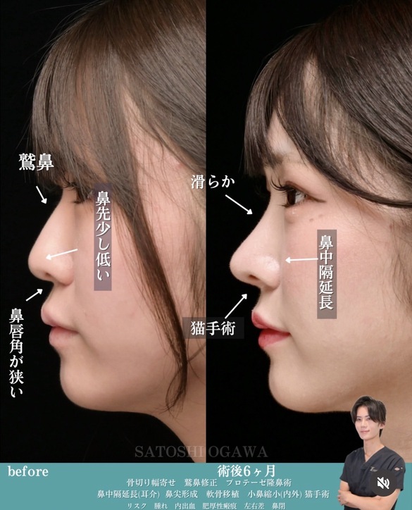 小川医師による鼻整形術前/術後6ヶ月 施術後 
