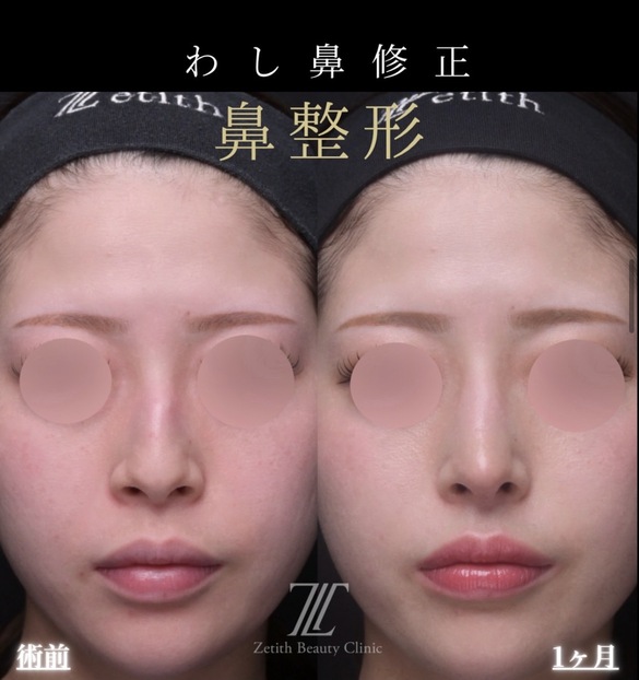 鼻整形