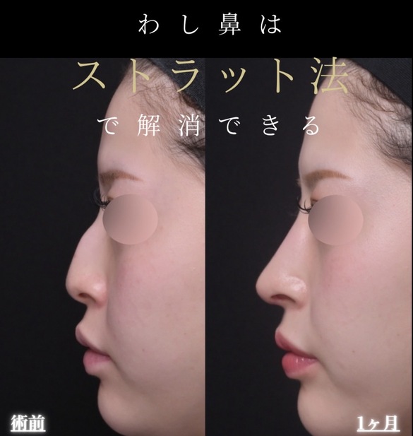 羽根医師による鼻整形術前/術後1ヶ月 施術後 