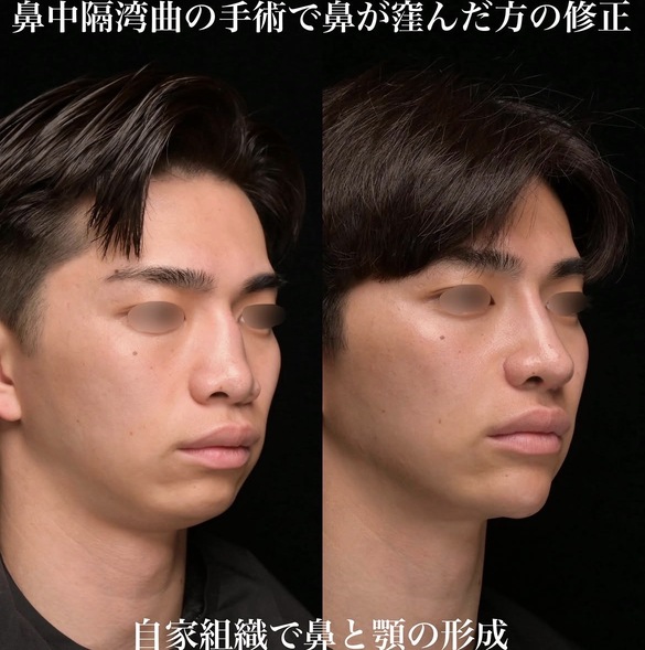 鉄医師による鼻整形術前/術後3ヶ月 After 