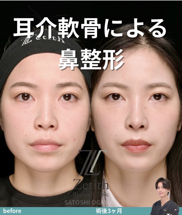 鼻整形