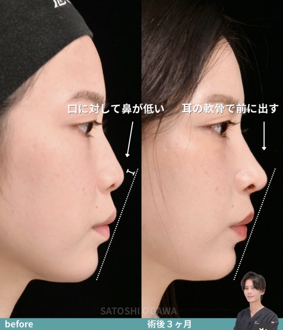 小川医師による鼻整形術前/術後3ヶ月 术后 