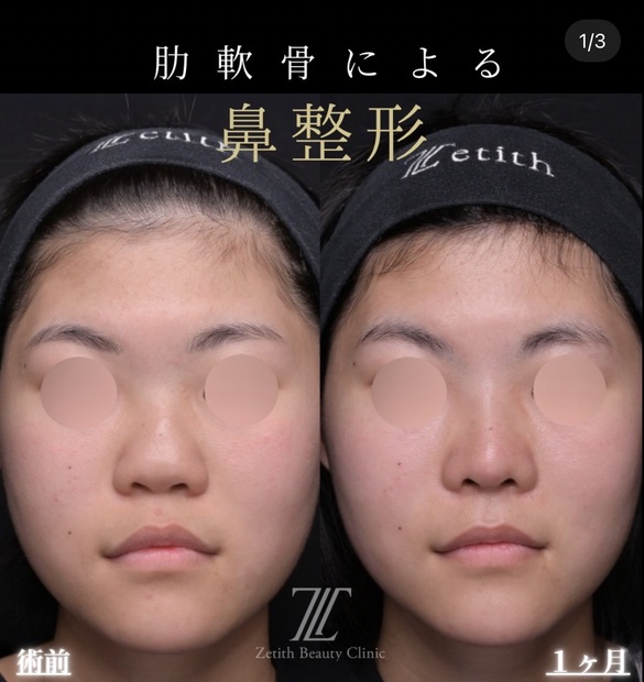 鼻整形