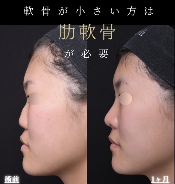 羽根医師による鼻整形術前/術後1ヶ月 施術後 