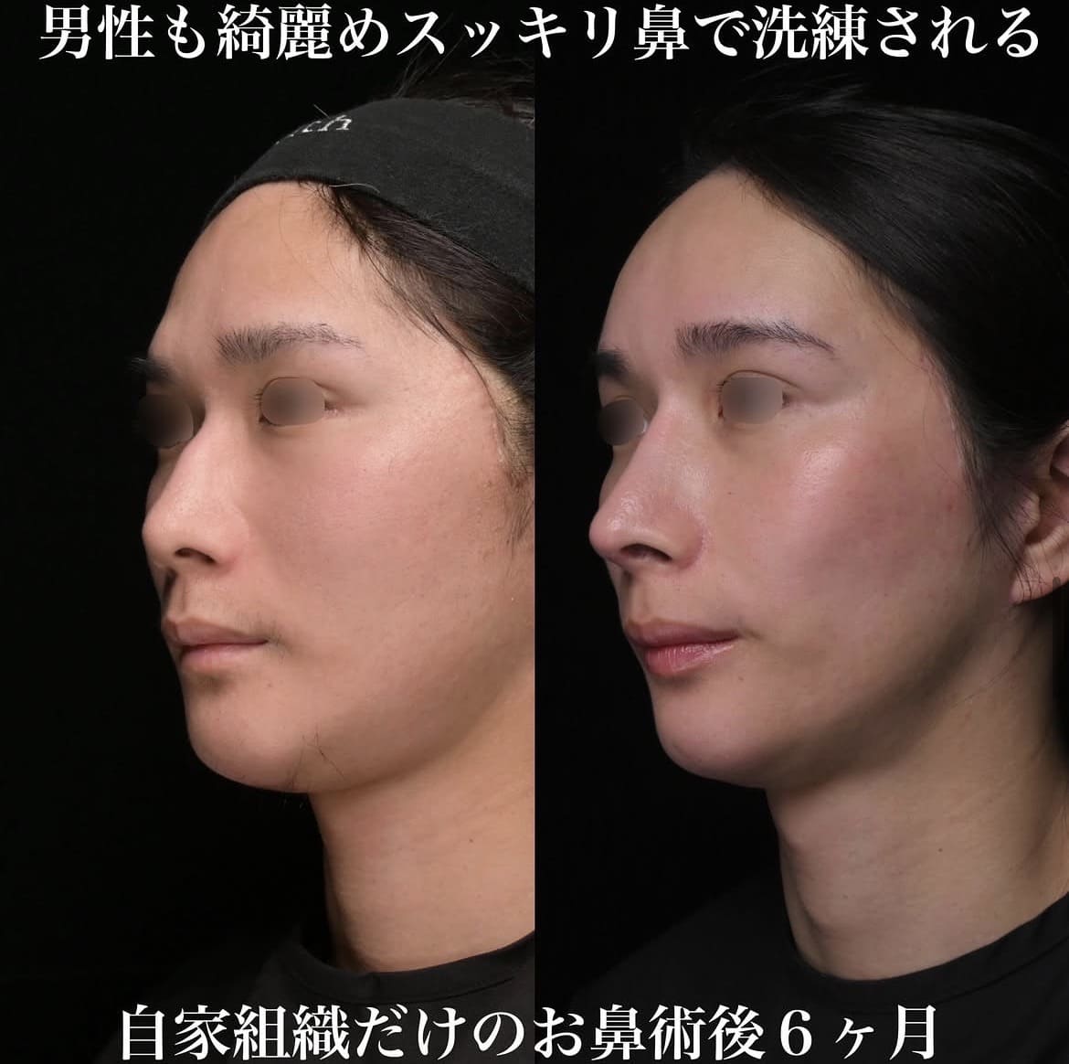 鉄医師による鼻整形術前/術後6ヶ月 术后 