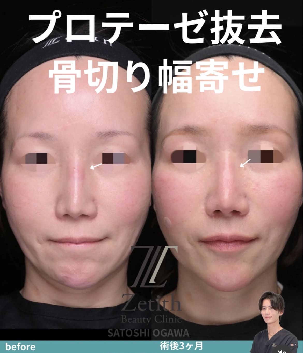 鼻整形