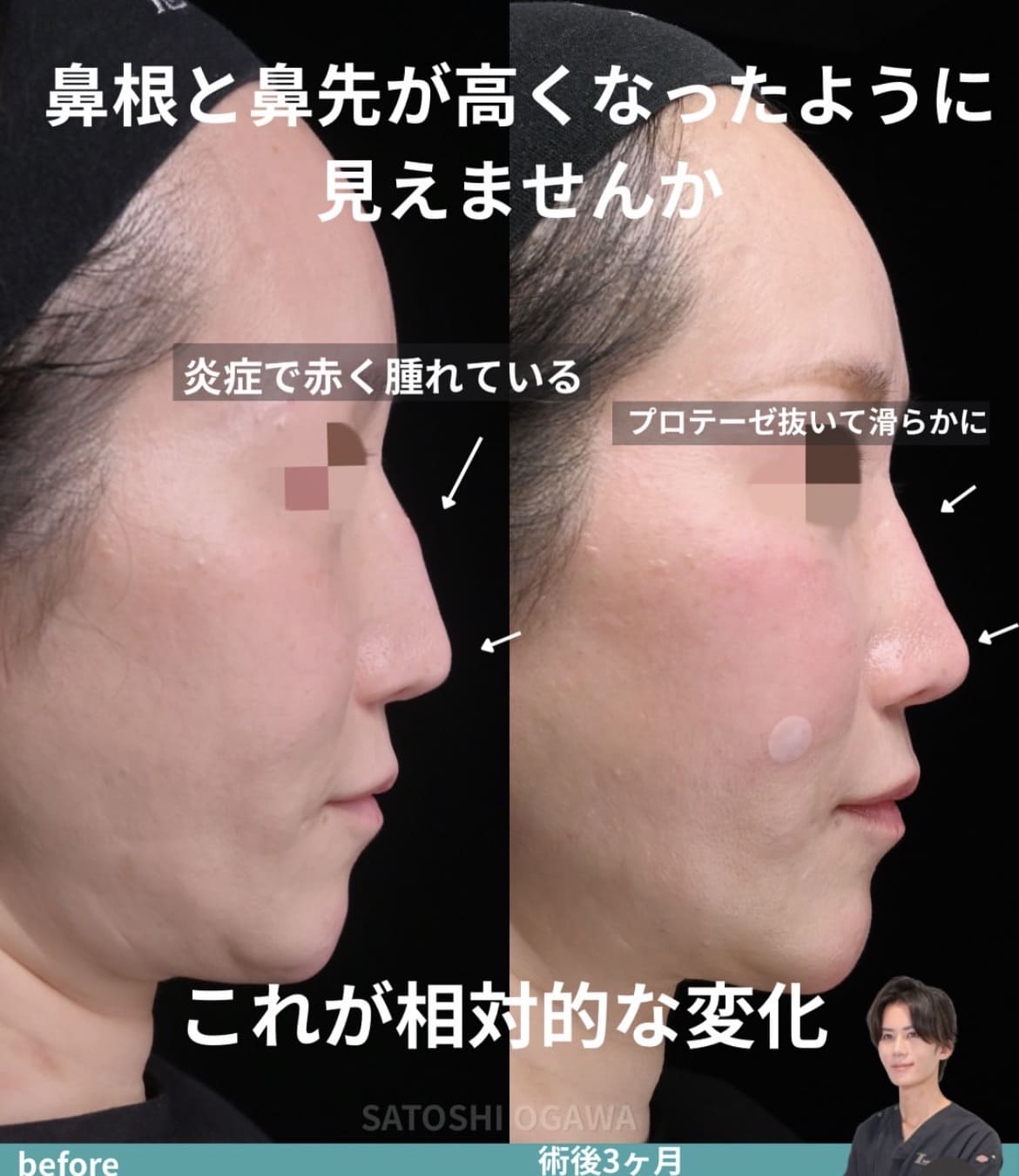 小川医師による鼻整形術前/術後3ヶ月 施術後 