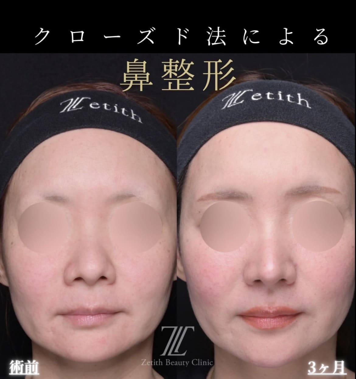 鼻整形