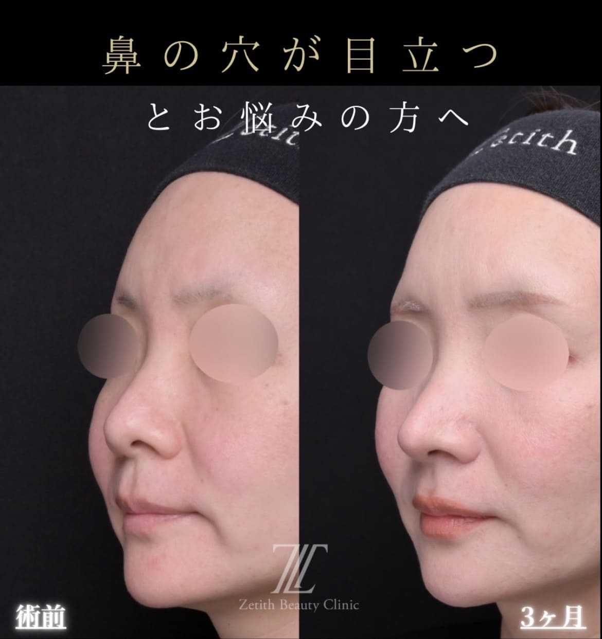 羽根医師による鼻整形術前/術後3ヶ月 بعد 