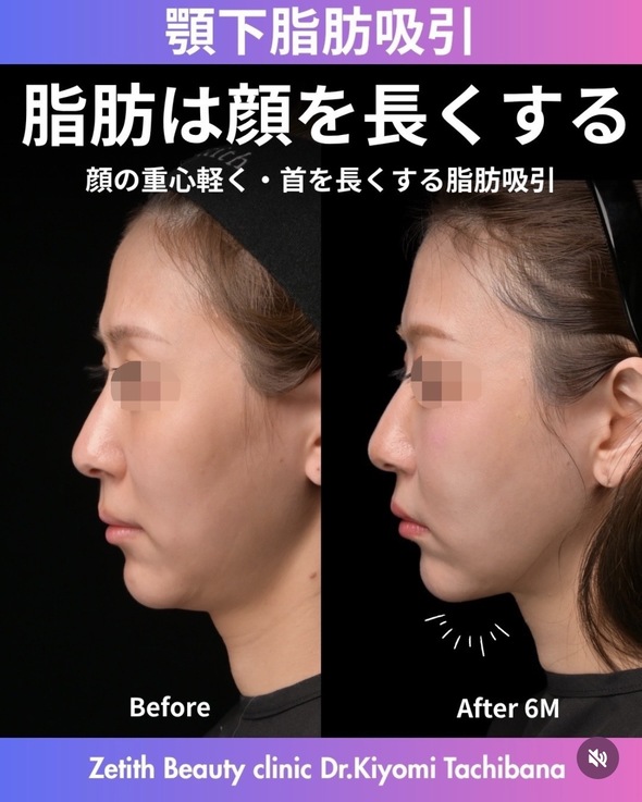 橘医師による脂肪吸引の術前/術後6ヶ月