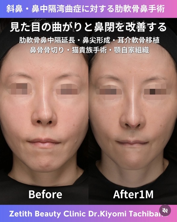 鼻整形