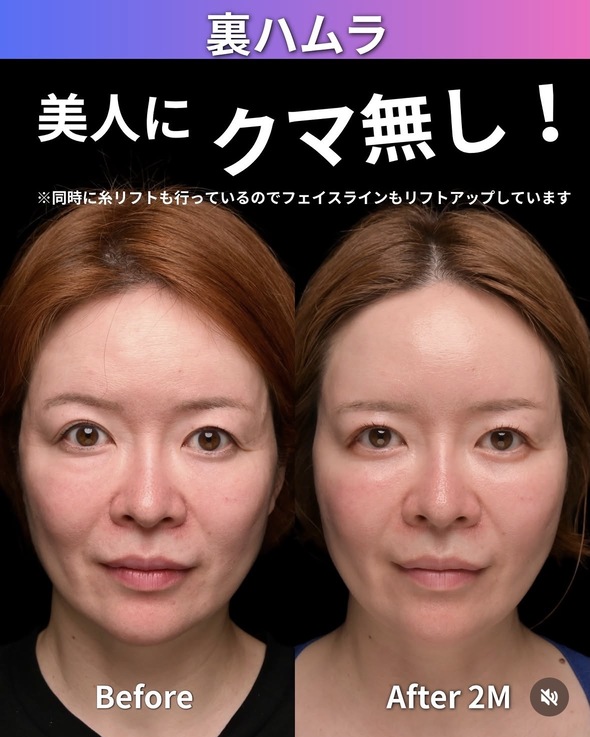橘医師による裏ハムラの術前/術後2週間 After 