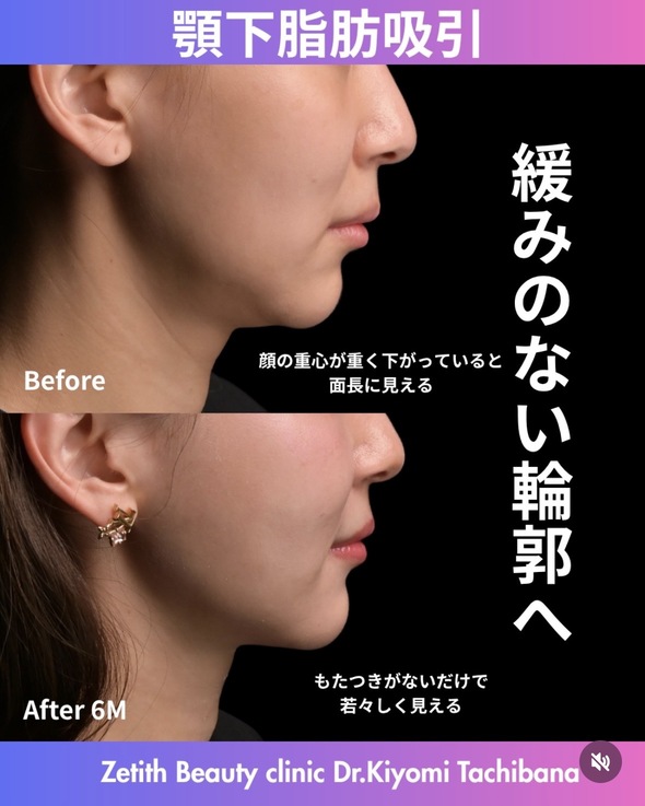 橘医師による脂肪吸引の術前/術後6ヶ月 施術後 