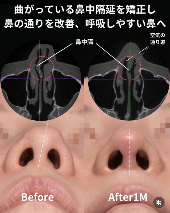 橘医師による鼻整形の術前/術後1ヶ月 施術後 