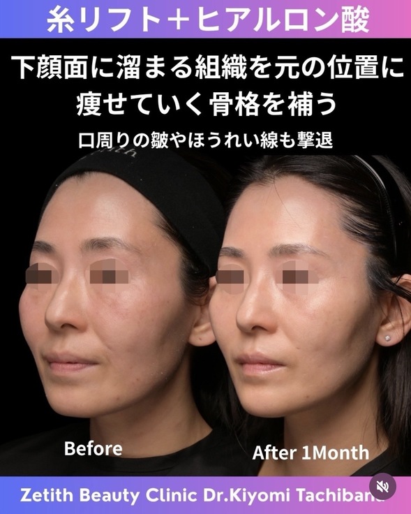 橘医師による複合施術の術前/術後1ヶ月 بعد 