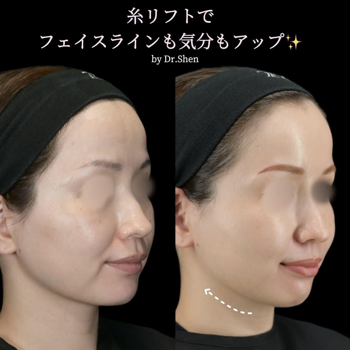 糸リフト