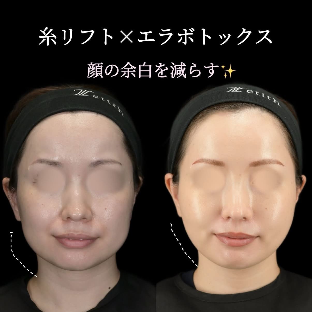 沈 医師による糸リフト 術前/術後1ヵ月 Sau 