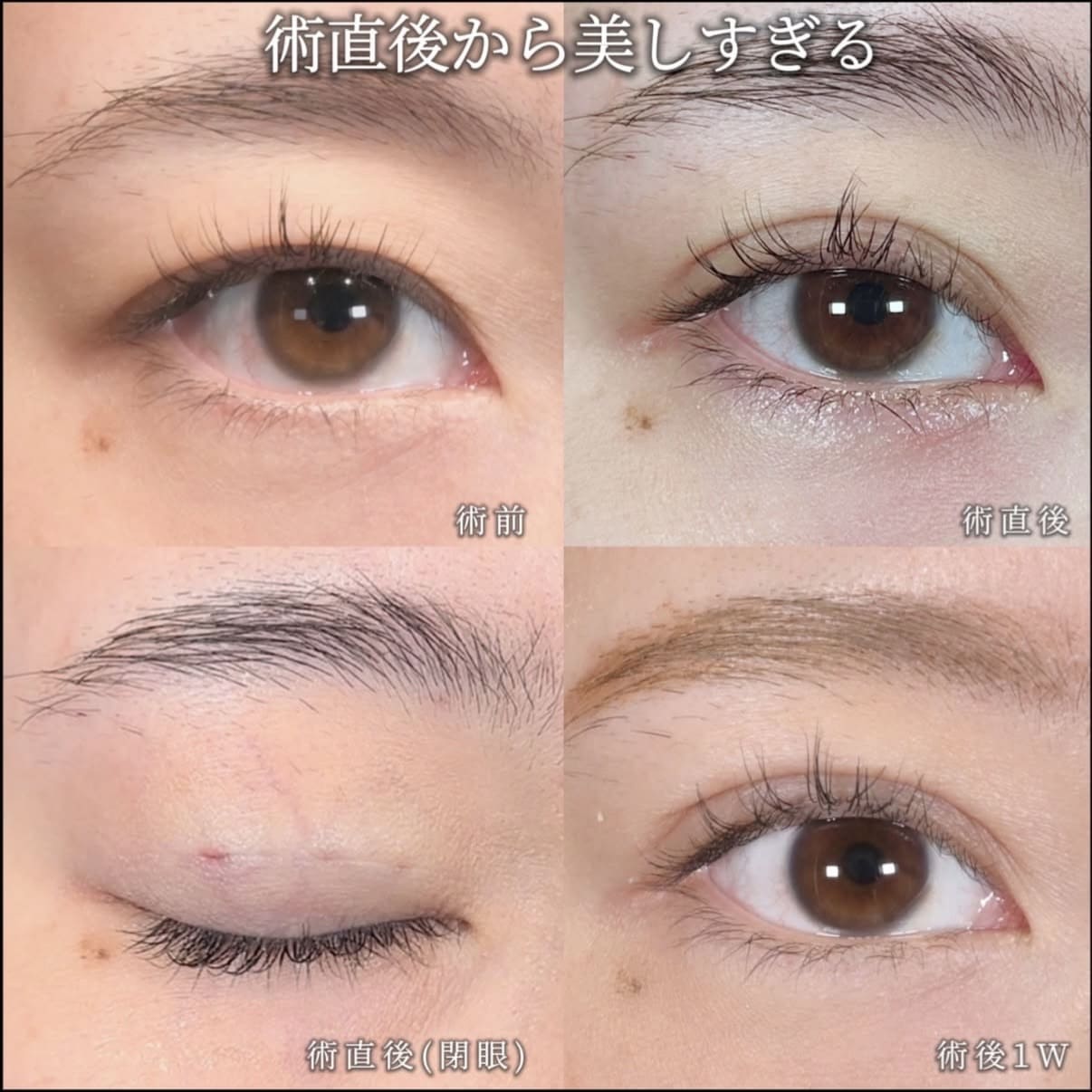 沈医師による目元整形術前/術後1週間 Sonra 
