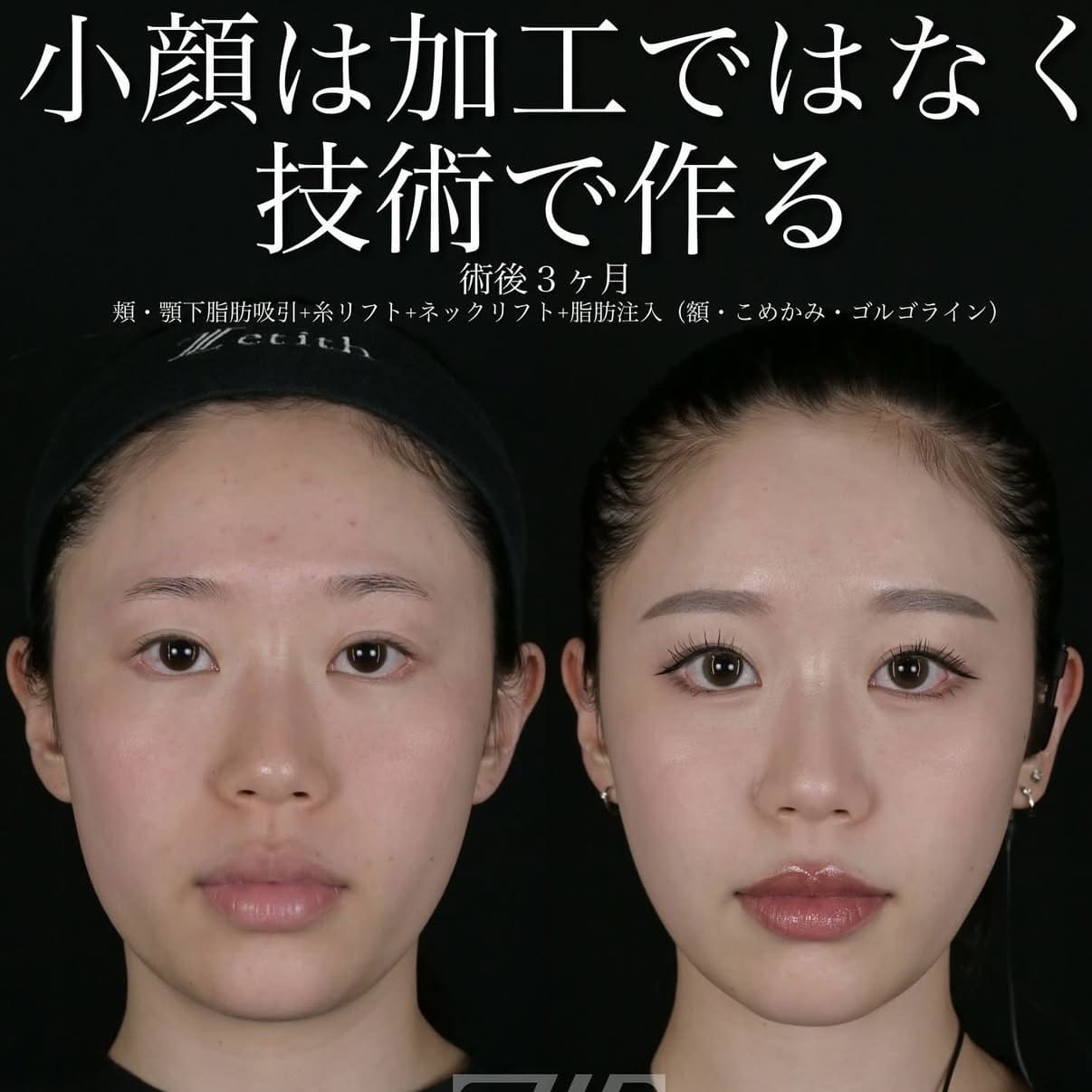 脂肪吸引リフト