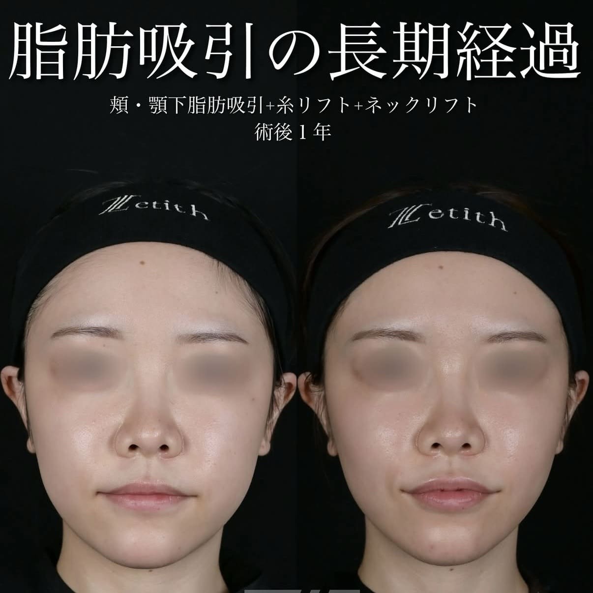 北村医師による脂肪吸引リフト術前/術後1年 施術後 