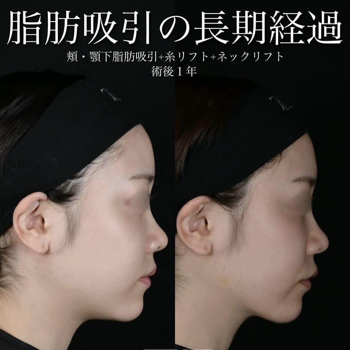 脂肪吸引リフト