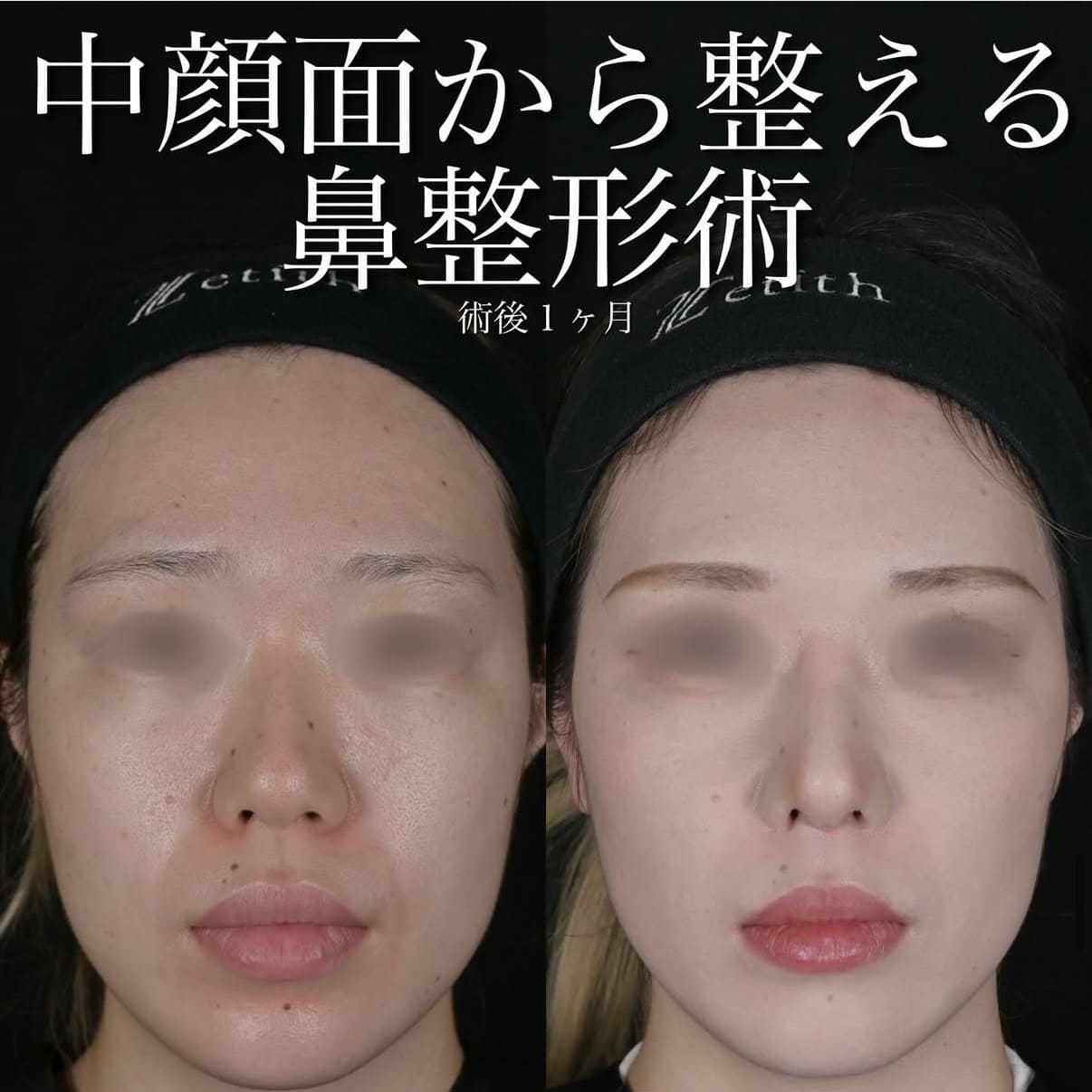 北村医師による鼻整形術前/術後1ヶ月 Sonra 