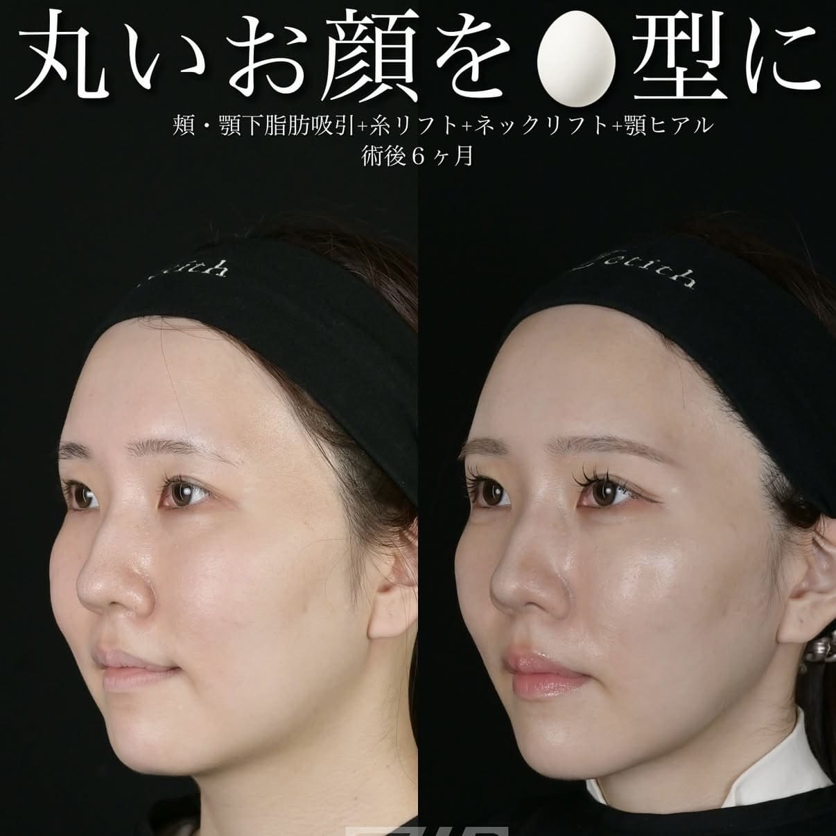 脂肪吸引リフト
