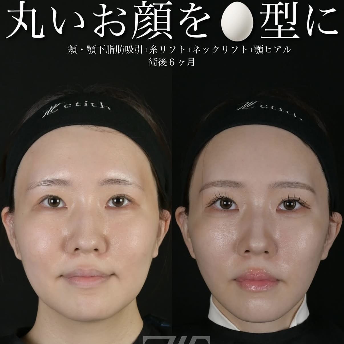 北村医師による脂肪吸引リフト術前/術後6ヵ月 بعد 
